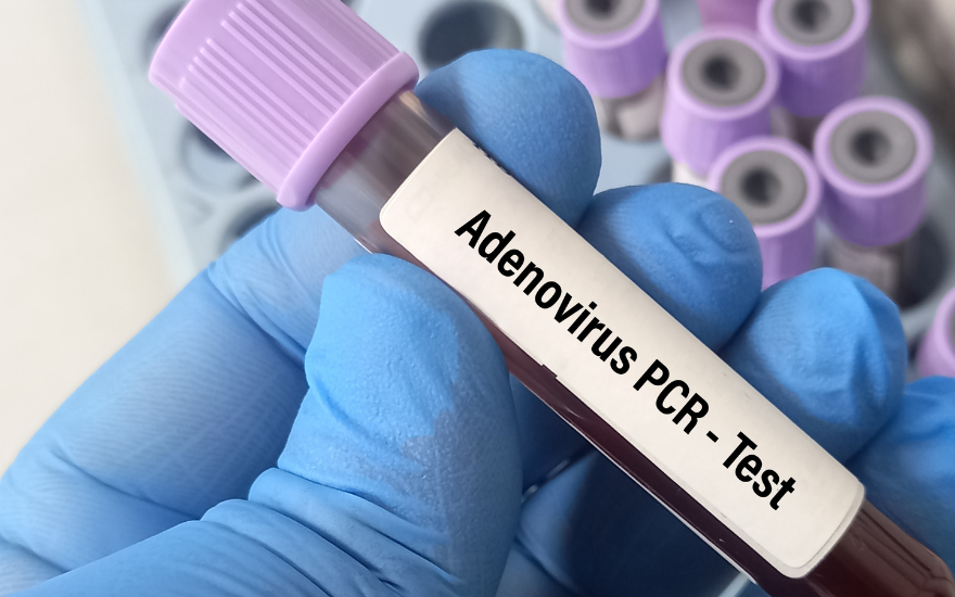 Key: phòng lây nhiễm Adenovirus cho trẻ  URL: phong-lay-nhiem-adenovirus-cho-tre  Meta: Hướng dẫn phòng lây nhiễm Adenovirus cho trẻ khi dịch gia tăng như rửa tay, vệ sinh đồ dùng, hạn chế nguồn lây và nhận biết sớm dấu hiệu cần đi khám kịp thời. Làm gì để phòng lây nhiễm Adenovirus cho trẻ khi đang có dịch? Phòng lây nhiễm Adenovirus cho trẻ cần được thực hiện đồng thời tại nhà, trường học và nơi công cộng khi số ca có xu hướng tăng trong mùa hè. Theo Báo Nhân Dân ngày 11/7/2026, từ đầu năm đã ghi nhận 2.777 trẻ dương tính, gấp 3 lần cùng kỳ năm 2025; riêng những ngày đầu tháng 7 có thêm 383 trường hợp tại cơ sở báo cáo. Bài viết dưới đây giúp phụ huynh hiểu đường lây, áp dụng đúng biện pháp phòng bệnh và nhận biết dấu hiệu cần đưa trẻ đi khám.  Trả lời nhanh: Phụ huynh nên cho trẻ rửa tay bằng xà phòng ít nhất 20 giây, không dùng chung đồ cá nhân, tránh tiếp xúc với người bệnh và vệ sinh thường xuyên đồ chơi, bề mặt dùng chung. Trẻ có biểu hiện sốt, ho, đau mắt đỏ, nôn hoặc tiêu chảy cần nghỉ ở nhà, không đi bơi và được đưa đi khám nếu khó thở, li bì, bỏ bú hoặc tiểu ít.  Chủ động phòng Adenovirus giúp bảo vệ trẻ trong mùa dịch  Tham vấn chuyên môn: BSCKII - Phạm Thị Như Hoa - Trưởng Khoa Nhi Bệnh Nhiệt Đới, Bệnh viện Đa khoa Hồng Ngọc. Ngày cập nhật: 17/07/2026. Tóm tắt nhanh bài viết:  Phụ huynh nên cho trẻ rửa tay bằng xà phòng ít nhất 20 giây, nhất là trước khi ăn, sau khi đi vệ sinh và sau khi ho, hắt hơi. Trẻ đang sốt, ho, đau mắt đỏ, nôn hoặc tiêu chảy cần nghỉ ở nhà và không đến bể bơi, khu vui chơi. Gia đình không nên dùng chung khăn mặt, cốc uống nước, thìa, đồ chơi ngậm miệng hoặc vật dụng vệ sinh mắt với trẻ đang mắc bệnh. Người chăm sóc cần vệ sinh đồ chơi, tay nắm cửa, mặt bàn và các bề mặt thường xuyên tiếp xúc bằng sản phẩm khử khuẩn phù hợp. Trẻ khó thở, li bì, co giật, bỏ bú, tiểu ít hoặc sốt cao kéo dài cần được đưa đi khám sớm. Vì sao Adenovirus dễ lây lan giữa trẻ em? Adenovirus có thể lây qua nhiều đường cùng lúc, gồm giọt bắn khi người bệnh ho hoặc hắt hơi, tiếp xúc gần, bàn tay và bề mặt nhiễm virus, phân của người bệnh và nguồn nước không được khử khuẩn đầy đủ. Trẻ có thể nhiễm bệnh khi chạm vào đồ chơi, tay nắm cửa hoặc vật dụng có virus rồi đưa tay lên mắt, mũi hoặc miệng. Virus cũng có thể phát tán trong quá trình thay tã hoặc chăm sóc trẻ bị tiêu chảy.  Trường học, lớp mầm non, khu vui chơi và bể bơi công cộng là những môi trường có nguy cơ lây chéo cao vì trẻ thường sinh hoạt gần nhau, dùng chung đồ vật và chưa duy trì tốt thói quen vệ sinh cá nhân. Đặc biệt, Adenovirus có thể tồn tại trên một số bề mặt và lây qua nước bể bơi nếu hệ thống lọc, vệ sinh hoặc khử khuẩn không bảo đảm. Vì vậy, phụ huynh nên cho trẻ nghỉ học, tạm dừng đi bơi và hạn chế đến nơi đông người khi trẻ đang sốt, ho, đau mắt đỏ, nôn hoặc tiêu chảy.  Đường lây Tình huống thường gặp Cách hạn chế Đường hô hấp Ho, hắt hơi, nói chuyện ở khoảng cách gần Che miệng, tăng thông khí, tránh tiếp xúc gần với người đang ốm Bàn tay và bề mặt Đồ chơi, tay nắm cửa, bàn ghế, điện thoại Rửa tay và vệ sinh bề mặt thường xuyên Đường phân – miệng Thay tã, đi vệ sinh, chăm sóc trẻ tiêu chảy Rửa tay sau thay tã, bỏ tã bẩn vào túi kín, khử khuẩn bề mặt thường xuyên Niêm mạc mắt Dùng chung khăn, chạm tay bẩn lên mắt Không dùng chung khăn và hạn chế dụi mắt Nguồn nước Bể bơi thiếu chlorine hoặc vệ sinh không bảo đảm Chọn bể bơi được quản lý tốt, không cho trẻ đang ốm đi bơi   Adenovirus dễ lây qua giọt bắn, bề mặt và nguồn nước Các biện pháp phòng lây nhiễm Adenovirus cho trẻ Phụ huynh có thể áp dụng các biện pháp dưới đây để giảm nguy cơ trẻ lây nhiễm Adenovirus. Hướng dẫn trẻ rửa tay đúng cách và đúng thời điểm Rửa tay bằng xà phòng là một trong những biện pháp quan trọng nhất để ngăn virus từ đồ vật, dịch tiết hoặc phân đi vào mắt, mũi và miệng. Trẻ nên làm ướt tay, tạo bọt, chà lòng bàn tay, mu bàn tay, kẽ ngón và vùng dưới móng trong ít nhất 20 giây, sau đó rửa sạch và lau khô. Phụ huynh cần nhắc trẻ rửa tay: Trước khi ăn hoặc chạm vào thức ăn. Sau khi đi vệ sinh hoặc thay tã. Sau khi ho, hắt hơi hoặc xì mũi. Sau khi đi học, đi bơi hoặc chơi ngoài trời. Sau khi chạm vào người đang ốm, khăn giấy hoặc dịch tiết. Khi không có xà phòng và nước sạch, người chăm sóc có thể dùng dung dịch sát khuẩn tay chứa ít nhất 60% cồn. Trẻ nhỏ cần được người lớn giám sát để tránh nuốt dung dịch hoặc đưa dung dịch vào mắt.  Rửa tay đúng cách giúp loại bỏ virus trên da Giữ vệ sinh hô hấp, đeo khẩu trang và làm phòng thông thoáng Phụ huynh nên hướng dẫn trẻ ho hoặc hắt hơi vào khăn giấy hay khuỷu tay áo, sau đó bỏ khăn giấy vào thùng rác và rửa tay. Trẻ không nên dùng bàn tay che miệng vì virus có thể tiếp tục phát tán sang đồ vật và người xung quanh.  Trẻ từ 2 tuổi trở lên có thể đeo khẩu trang khi đến cơ sở y tế, đi phương tiện công cộng hoặc ở nơi đông người, thông khí kém. Gia đình cũng nên mở cửa sổ khi điều kiện cho phép và hạn chế để trẻ ở lâu trong phòng kín. Khẩu trang cần che kín mũi, miệng và được thay khi ẩm hoặc bẩn.  Đeo khẩu trang giúp hạn chế giọt bắn Hạn chế trẻ tiếp xúc với nguồn lây Trẻ đang sốt, ho nhiều, đau mắt đỏ, nôn hoặc tiêu chảy nên nghỉ học, không đi bơi và tránh đến khu vui chơi hoặc nơi đông người. Việc cho trẻ nghỉ tại nhà vừa hỗ trợ quá trình hồi phục vừa giảm nguy cơ lây bệnh cho cộng đồng.  Nếu trong gia đình có người đang mắc bệnh, phụ huynh nên hạn chế ôm hôn, tiếp xúc mặt đối mặt và dùng chung vật dụng với trẻ. Người chăm sóc cần rửa tay sau khi lau mũi, vệ sinh mắt, thay tã hoặc xử lý chất nôn, đồng thời không để trẻ khỏe chơi với đồ chơi chưa được làm sạch.  Trẻ nên tránh tiếp xúc gần với người đang mắc bệnh Giữ vệ sinh cơ thể, đồ dùng và không gian sống Phụ huynh nên tắm rửa, thay quần áo cho trẻ sau khi trở về từ trường học, khu vui chơi hoặc nơi đông người. Tay nắm cửa, công tắc, mặt bàn, điện thoại, nhà vệ sinh và đồ chơi dùng chung cũng cần được vệ sinh thường xuyên bằng sản phẩm phù hợp, đúng hướng dẫn trên nhãn.  Trẻ không nên dùng chung khăn mặt, khăn tắm, gối, cốc uống nước, thìa, thuốc nhỏ mắt hoặc vật dụng vệ sinh cá nhân. Đồ chơi trẻ thường đưa vào miệng cần được làm sạch sau khi sử dụng và không chuyển ngay cho trẻ khác.  Đồ dùng của trẻ cần được vệ sinh thường xuyên Chăm sóc an toàn khi trẻ đau mắt đỏ hoặc tiêu chảy Adenovirus có thể gây viêm kết mạc, nôn và tiêu chảy. Khi trẻ đỏ mắt hoặc chảy nhiều dịch mắt, người chăm sóc không nên dùng chung khăn lau giữa hai mắt hoặc giữa các thành viên trong gia đình. Khăn vải cần được giặt sạch và làm khô; bông hoặc khăn giấy dùng một lần phải được bỏ ngay sau khi sử dụng.  Khi thay tã hoặc vệ sinh cho trẻ tiêu chảy, người chăm sóc cần xử lý tã đúng cách và rửa tay ngay sau đó. Gia đình nên duy trì vệ sinh tay và đồ dùng sau khi triệu chứng cải thiện vì virus có thể tiếp tục được đào thải trong một khoảng thời gian.  Vệ sinh đúng cách giúp hạn chế virus phát tán Thận trọng khi cho trẻ đi bơi Adenovirus có thể lây qua nguồn nước nếu bể bơi không được lọc và khử khuẩn đúng cách. Phụ huynh nên lựa chọn bể bơi có quy trình vệ sinh rõ ràng, đồng thời không cho trẻ đi bơi khi đang sốt, ho nhiều, đau mắt đỏ, nôn hoặc tiêu chảy.  Trong thời điểm số ca bệnh gia tăng, gia đình có thể giảm các buổi bơi tại bể công cộng đông người. Trẻ sơ sinh, trẻ có bệnh tim phổi mạn tính hoặc suy giảm miễn dịch cần được bảo vệ thận trọng hơn.  Không cho trẻ đang mắc bệnh đến bể bơi Duy trì bú mẹ và chế độ ăn đầy đủ dưỡng chất Trẻ nên được bú mẹ hoàn toàn trong 6 tháng đầu nếu điều kiện sức khỏe của mẹ và bé cho phép, sau đó ăn bổ sung phù hợp và tiếp tục bú mẹ đến 2 tuổi hoặc lâu hơn. Sữa mẹ cung cấp dinh dưỡng và kháng thể, góp phần hỗ trợ trẻ chống lại nhiều bệnh nhiễm trùng thường gặp.  Từ 6 tháng tuổi, trẻ cần được ăn đa dạng các nhóm thực phẩm như thịt, cá, trứng, sữa, đậu, rau xanh và trái cây. Phụ huynh nên cho trẻ uống đủ nước, ăn chín uống sôi và không tự ý sử dụng vitamin hoặc sản phẩm quảng cáo “tăng đề kháng”. Bú mẹ và dinh dưỡng đầy đủ giúp duy trì thể trạng nhưng không phòng đặc hiệu Adenovirus.  Dinh dưỡng đầy đủ giúp trẻ duy trì thể trạng khỏe mạnh Phối hợp với trường học và cơ sở trông trẻ Trường học và lớp mầm non cần duy trì khu vực rửa tay, vệ sinh đồ chơi, làm thông thoáng lớp học và theo dõi trẻ có dấu hiệu bất thường. Khi trẻ xuất hiện sốt, đau mắt đỏ, nôn hoặc tiêu chảy, nhà trường nên thông báo cho gia đình và hạn chế để trẻ tiếp xúc gần với các bạn trong thời gian chờ đón.  Phụ huynh nên thông báo cho nhà trường khi trẻ được chẩn đoán mắc Adenovirus. Thông tin kịp thời giúp cơ sở giáo dục tăng cường vệ sinh, theo dõi các trường hợp liên quan và chủ động thực hiện biện pháp hạn chế lây nhiễm.  Gia đình và nhà trường cần phối hợp phòng lây nhiễm Nếu trong nhà đã có trẻ mắc Adenovirus, cha mẹ nên làm gì? Gia đình nên áp dụng đồng thời nhiều biện pháp thay vì chỉ tập trung vào một việc như nhỏ nước muối sinh lý hoặc xịt khử khuẩn. Nước muối có thể hỗ trợ làm sạch dịch mũi theo hướng dẫn phù hợp nhưng không thay thế việc rửa tay, hạn chế tiếp xúc và vệ sinh bề mặt. Phụ huynh có thể thực hiện theo thứ tự sau: Cho trẻ nghỉ tại nhà: Trẻ không nên đi học, đi bơi hoặc đến nơi đông người khi còn biểu hiện bệnh. Giảm tiếp xúc gần: Gia đình nên hạn chế để trẻ dùng chung giường, khăn, cốc và đồ chơi với anh chị em. Kiểm soát dịch tiết: Người chăm sóc cần rửa tay sau khi lau mũi, mắt, dọn chất nôn hoặc thay tã. Vệ sinh vật dụng chung: Tay nắm cửa, bàn ăn, bồn rửa và nhà vệ sinh cần được vệ sinh thường xuyên. Theo dõi toàn trạng: Phụ huynh cần quan sát nhịp thở, mức độ tỉnh táo, khả năng ăn bú, lượng nước tiểu, nôn và tiêu chảy. Adenovirus là virus nên kháng sinh không có tác dụng trực tiếp. Phụ huynh không nên tự cho trẻ dùng kháng sinh, tự phối hợp thuốc hạ sốt hoặc dùng thuốc nhỏ mắt có kháng sinh, corticoid khi chưa được bác sĩ thăm khám. Hiện cũng chưa có thuốc kháng virus đặc hiệu được phê duyệt cho đa số trường hợp nhiễm Adenovirus thông thường.  Gia đình cần chủ động hạn chế lây nhiễm chéo Khi nào trẻ cần được đưa đi khám? Phụ huynh cần đưa trẻ đi khám sớm nếu trẻ sốt cao kéo dài, ho tăng dần, đau mắt đỏ nhiều, nôn, tiêu chảy hoặc ăn uống kém. Trẻ có bệnh tim, bệnh phổi, suy giảm miễn dịch hoặc còn quá nhỏ cần được đánh giá sớm hơn vì nguy cơ diễn biến nặng cao hơn.  Trẻ cần được đưa đến cơ sở y tế hoặc cấp cứu ngay khi có một trong các dấu hiệu: Khó thở, thở gắng sức, rút lõm lồng ngực hoặc tím môi. Li bì, khó đánh thức, phản ứng chậm hoặc co giật. Không uống được, bỏ bú hoặc nôn liên tục. Tiểu ít, tã khô lâu, môi khô, mắt trũng hoặc khóc không có nước mắt. Trẻ dưới 3 tháng tuổi sốt từ 38°C trở lên. Đau mắt dữ dội, sợ ánh sáng hoặc thị lực thay đổi. Sốt cao khó hạ hoặc kéo dài trên nhiều ngày.  Phụ huynh có thể tham khảo thêm bài viết trẻ sốt mùa hè khi nào nguy hiểm để nhận biết các biểu hiện khó thở, mất nước, co giật và thay đổi ý thức cần được bác sĩ đánh giá. Những dấu hiệu này không đủ để tự chẩn đoán Adenovirus vì nhiều bệnh nhiễm trùng ở trẻ có thể biểu hiện tương tự.  Đưa trẻ đi khám khi xuất hiện dấu hiệu bất thường Câu hỏi thường gặp về phòng lây nhiễm Adenovirus cho trẻ  Adenovirus đã có vắc xin phòng bệnh cho trẻ chưa? Hiện chưa có thuốc điều trị đặc hiệu cho Adenovirus. Phác đồ điều trị chủ yếu tập trung vào việc giảm triệu chứng và tăng sức đề kháng. Vắc xin phòng Adenovirus type 4 và 7 chỉ được sử dụng trong một số nhóm quân nhân Hoa Kỳ, không được phê duyệt cho cộng đồng. Vì vậy, vệ sinh tay, hạn chế tiếp xúc nguồn bệnh và kiểm soát môi trường vẫn là biện pháp phòng ngừa chính. Trẻ từng mắc Adenovirus có thể mắc lại không? Trẻ có thể mắc lại vì Adenovirus gồm nhiều type khác nhau và lần nhiễm trước không đồng nghĩa trẻ được bảo vệ trước tất cả các type. Gia đình vẫn cần duy trì các biện pháp vệ sinh và phòng lây sau khi trẻ đã khỏi bệnh. Trẻ không có triệu chứng có cần xét nghiệm Adenovirus không? Trẻ khỏe mạnh, không có triệu chứng thường không cần tự làm xét nghiệm chỉ vì đang có nhiều ca bệnh. Bác sĩ sẽ cân nhắc xét nghiệm dựa trên triệu chứng, mức độ bệnh, tiền sử tiếp xúc và nguy cơ biến chứng. Phụ huynh không nên xem kết quả xét nghiệm là yếu tố duy nhất để quyết định chăm sóc hoặc điều trị. Người lớn có thể lây Adenovirus cho trẻ không? Có. Adenovirus có thể gây bệnh ở mọi lứa tuổi và lây qua tiếp xúc gần, ho, hắt hơi, bàn tay, bề mặt, phân hoặc nguồn nước nhiễm virus. Người lớn đang có triệu chứng nên hạn chế tiếp xúc gần, không dùng chung vật dụng và rửa tay trước khi chăm sóc trẻ. Kết luận Phòng lây nhiễm Adenovirus cho trẻ cần dựa trên nhiều lớp bảo vệ, gồm rửa tay đúng cách, che miệng khi ho, giữ không gian thông thoáng, không dùng chung đồ cá nhân, vệ sinh bề mặt và cho trẻ đang ốm nghỉ tại nhà. Phụ huynh không nên quá hoang mang nhưng cũng không nên chỉ dựa vào thuốc bổ, nước muối sinh lý hoặc tự dùng kháng sinh để phòng bệnh.  Nếu trẻ sốt cao kéo dài, ho tăng, đau mắt đỏ, nôn, tiêu chảy hoặc có dấu hiệu khó thở, mất nước và giảm tỉnh táo, gia đình nên đưa trẻ đến cơ sở y tế. Khoa Nhi Bệnh nhiệt đới - Bệnh viện Đa Khoa Hồng Ngọc tiếp nhận thăm khám các bệnh lý hô hấp ở trẻ và triển khai sàng lọc, phân luồng bệnh nhi nghiêm ngặt nhằm hạn chế lây nhiễm chéo; đảm bảo an toàn trong suốt quá trình thăm khám và điều trị.  Lưu ý y khoa: Bài viết chỉ có giá trị tham khảo, không thay thế việc thăm khám, chẩn đoán hoặc điều trị của bác sĩ. Phụ huynh nên đưa trẻ đi khám sớm nếu trẻ sốt cao kéo dài, khó thở, li bì, bỏ bú, nôn nhiều, tiểu ít hoặc đau mắt kèm thay đổi thị lực. Tài liệu tham khảo:  CDC. About Adenovirus, cập nhật ngày 16/12/2025. CDC. Guidelines for Adenovirus Outbreaks, cập nhật ngày 17/12/2025. CDC. About Handwashing, hướng dẫn rửa tay tối thiểu 20 giây. WHO. Infection Prevention and Control, hướng dẫn chung về vệ sinh tay, vệ sinh hô hấp và kiểm soát lây nhiễm. American Academy of Pediatrics. Adenovirus Infections in Infants and Children. CDC. When Students or Staff Are Sick, hướng dẫn nghỉ học và quay lại trường.