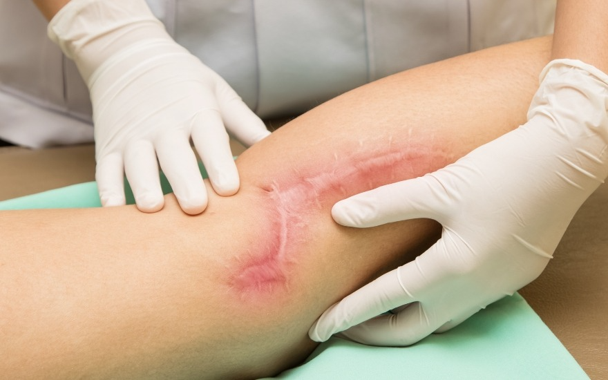 Chăm sóc sẹo sẽ có tác dụng hơn việc kiêng hoàn toàn rau muống