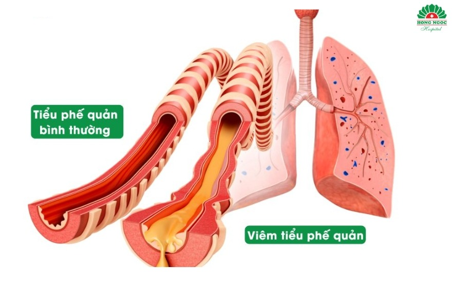 Tiểu phế quản khi viêm