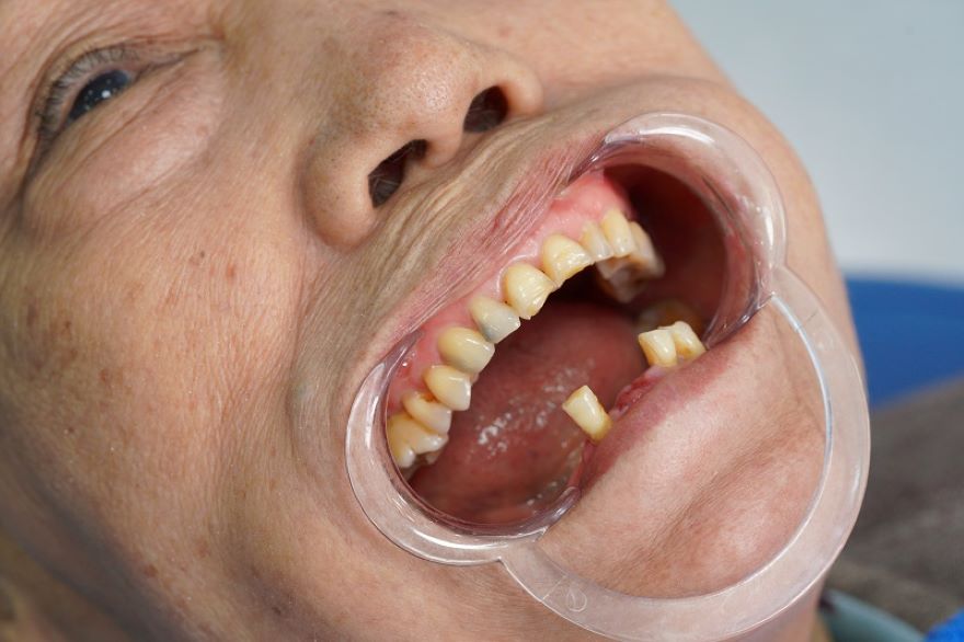 cấy ghép implant