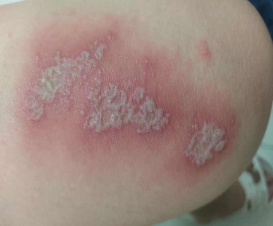 viêm da tiếp xúc do côn trùng