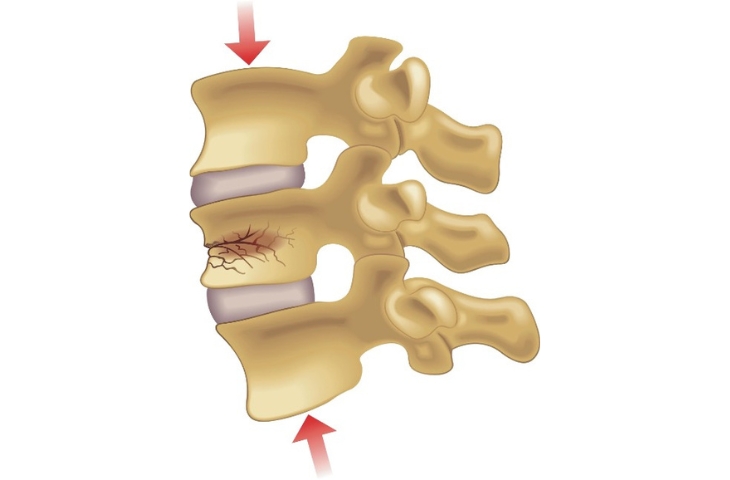 loãng xương nặng có xẹp đốt sống