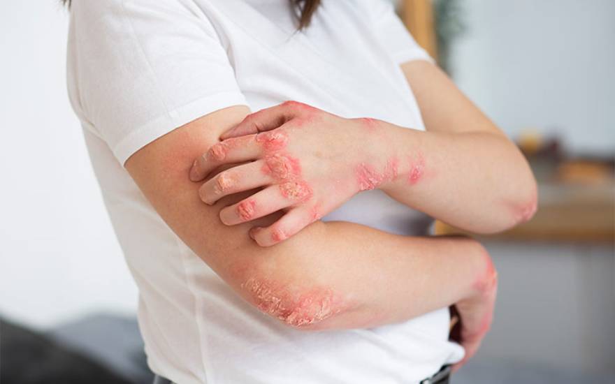 Lupus ban đỏ hệ thống