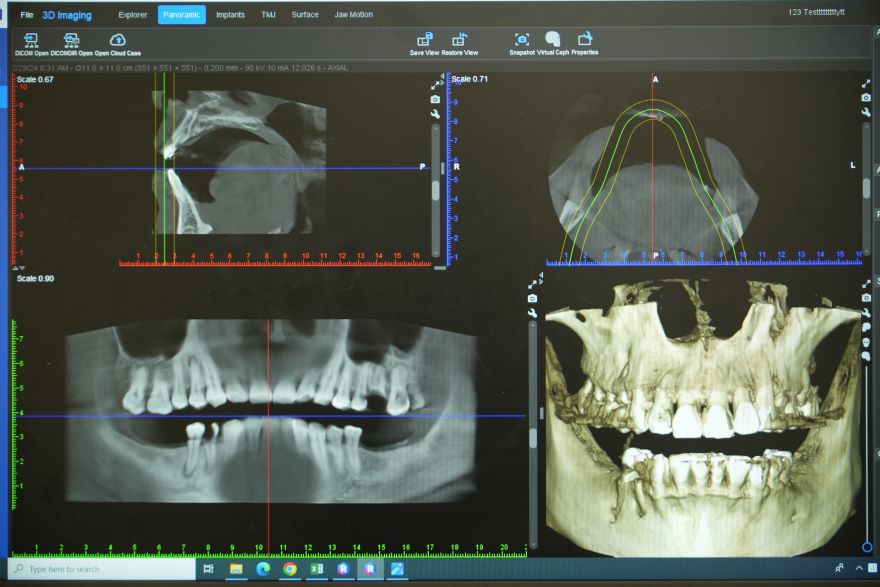 mất răng hàm dưới