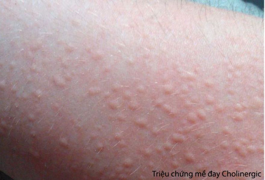 mày đay cholinergic