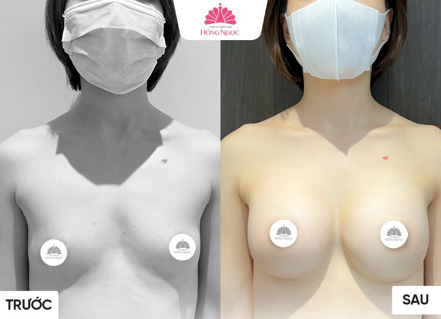 nâng ngực