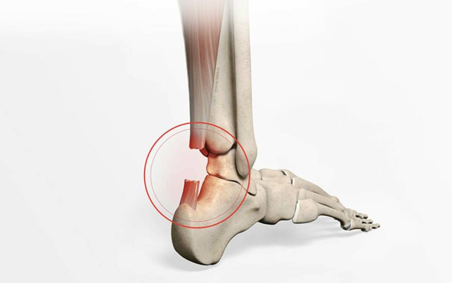 phẫu thuật nối gân achilles