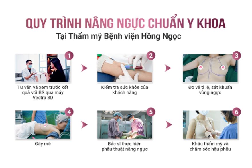 phẫu thuật nâng ngực Dual Plane