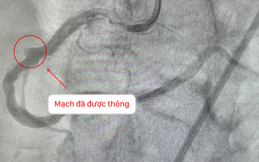 Stent Mach Vanh.1