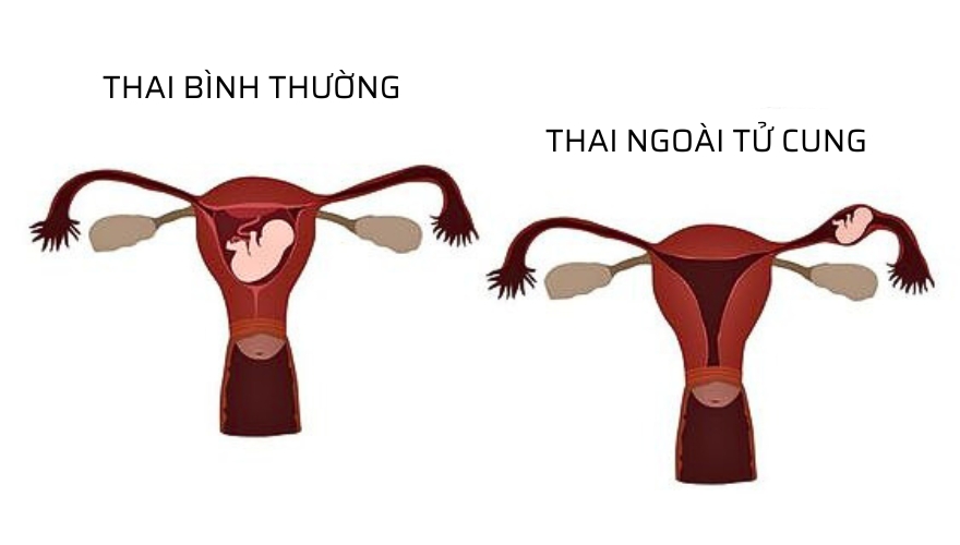 Thai ngoài tử cung