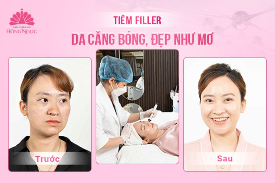 Tiêm filler tại Bệnh viện Hồng Ngọc