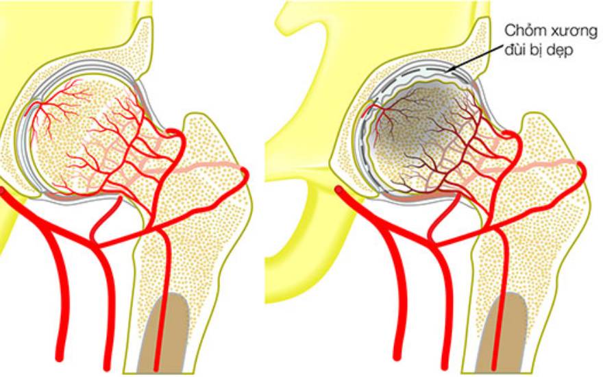 tiêu chỏm xương đùi vô khuẩn