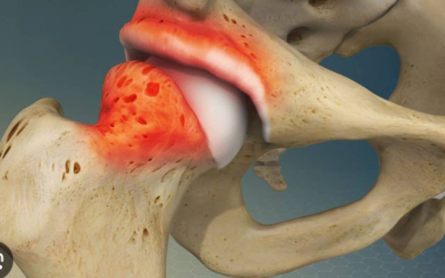 tiêu chỏm xương đùi vô khuẩn