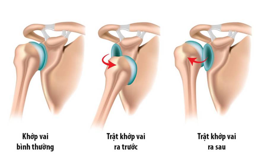 trật khớp vai