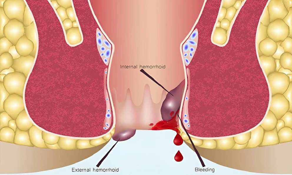 Thrombosed internal hemorrhoids