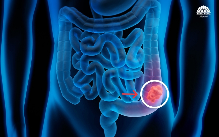 ung-thu-dai-truc-trang