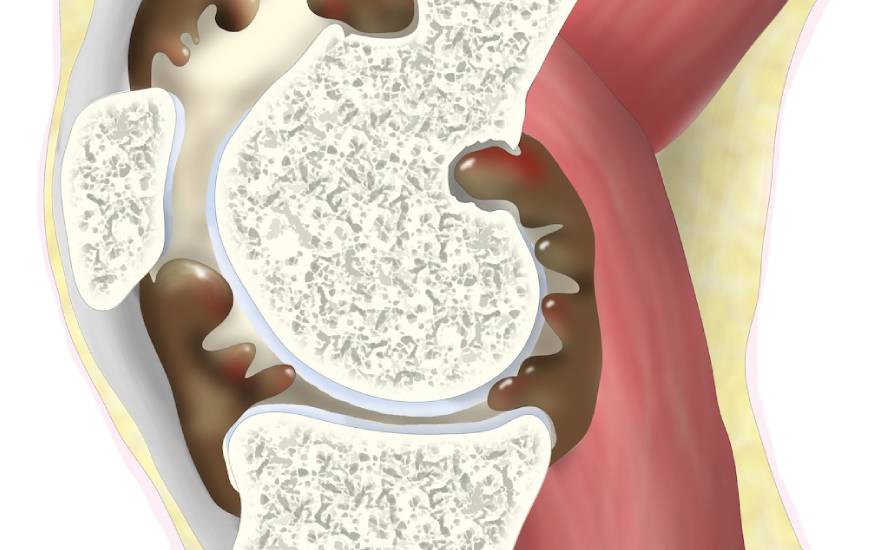 viêm màng hoạt dịch thể lông nốt sắc tố