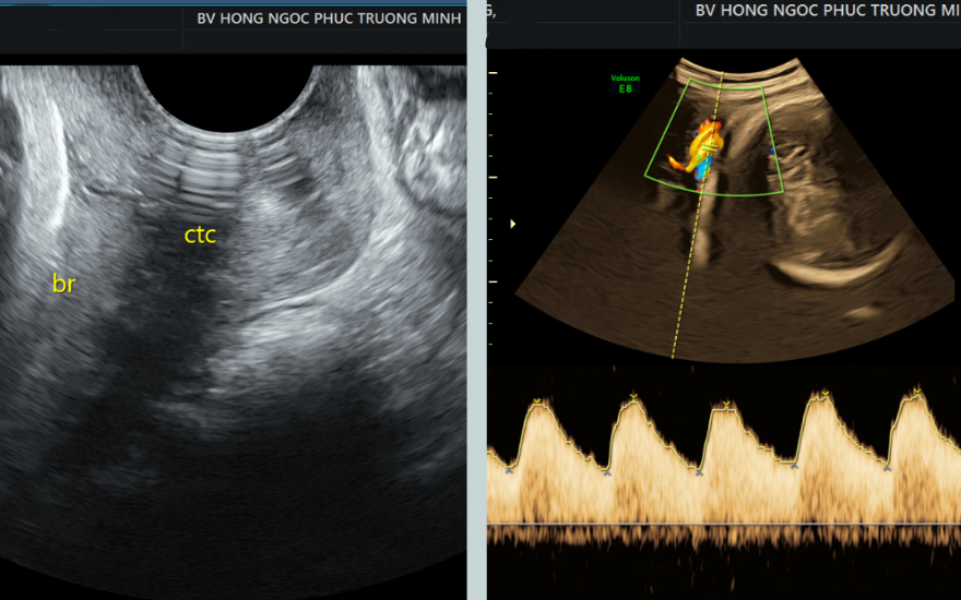 rau tiền đạo, dây rốn quấn cổ