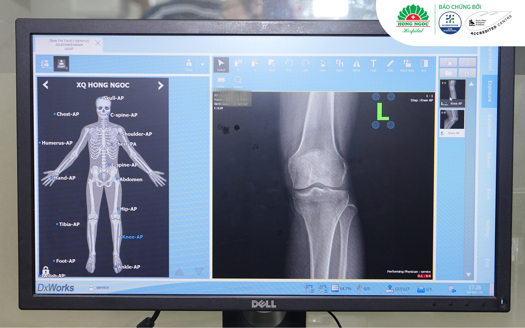Chụp X-quang giúp phát hiện tình trạng thoái hóa khớp gối