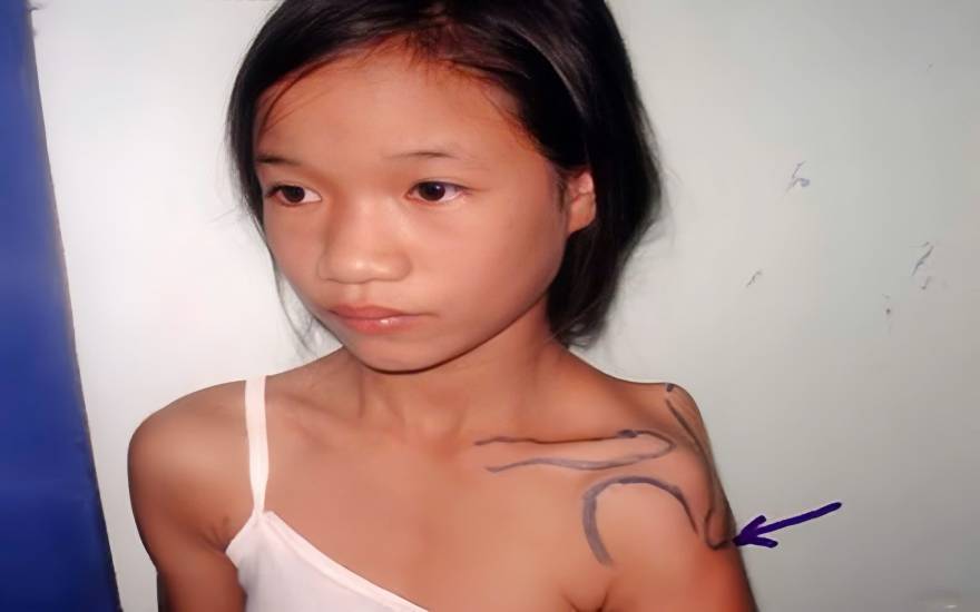 xơ hóa cơ dalta