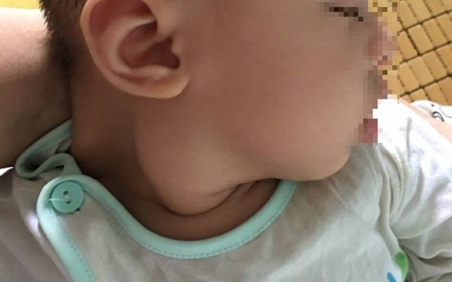 xơ hóa cơ ức đòn chũm