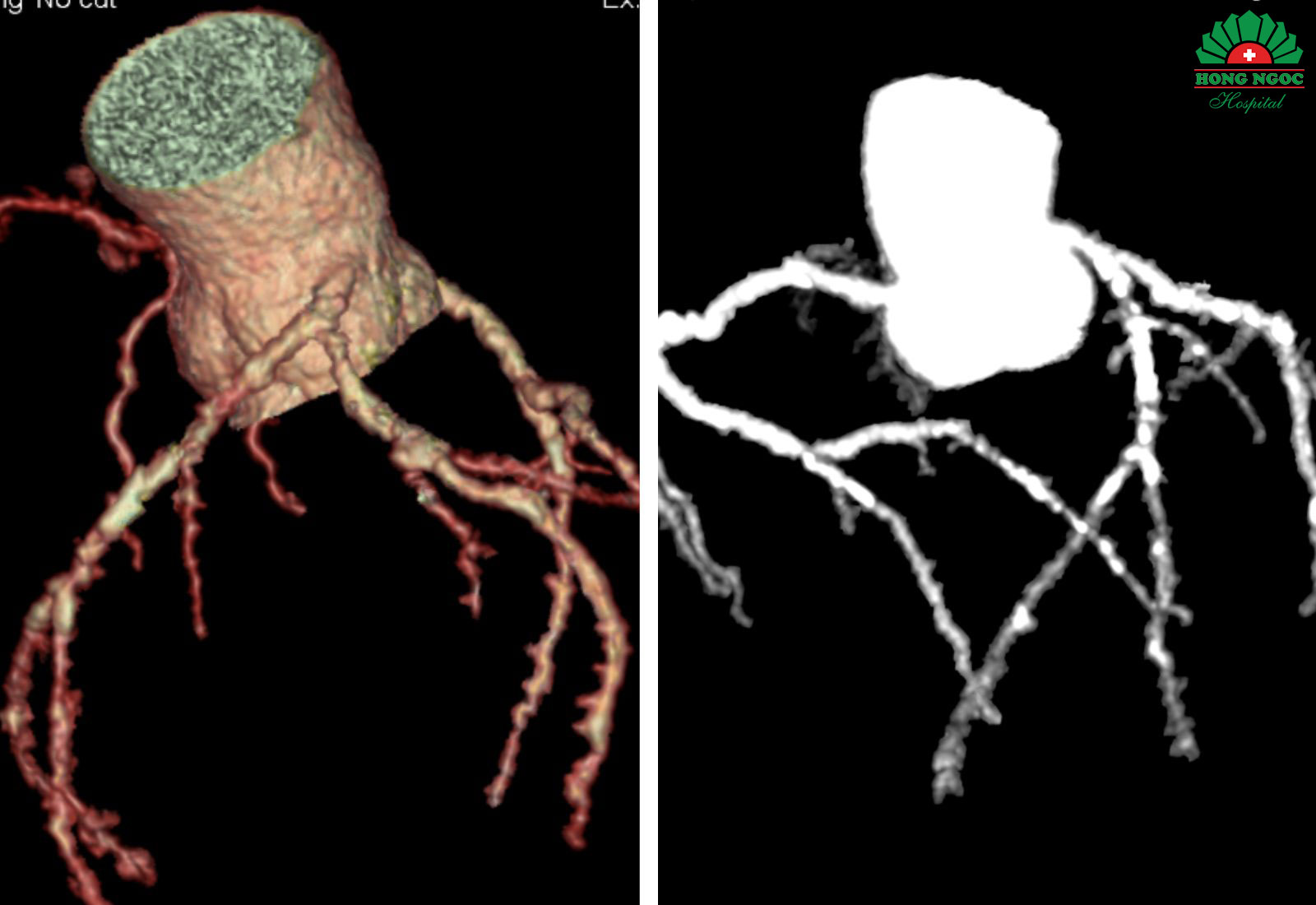 Coronary arteries with severe stenosis and diffuse calcification