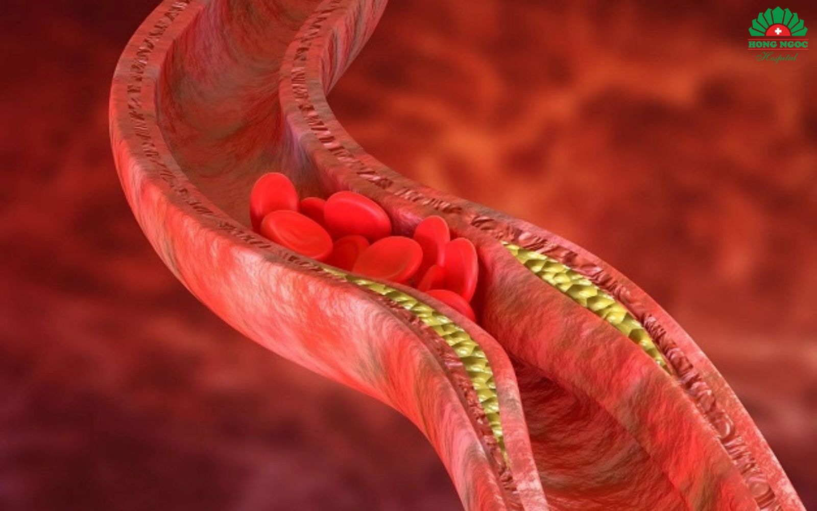 Coronary artery obstruction is the leading cause of heart stroke.