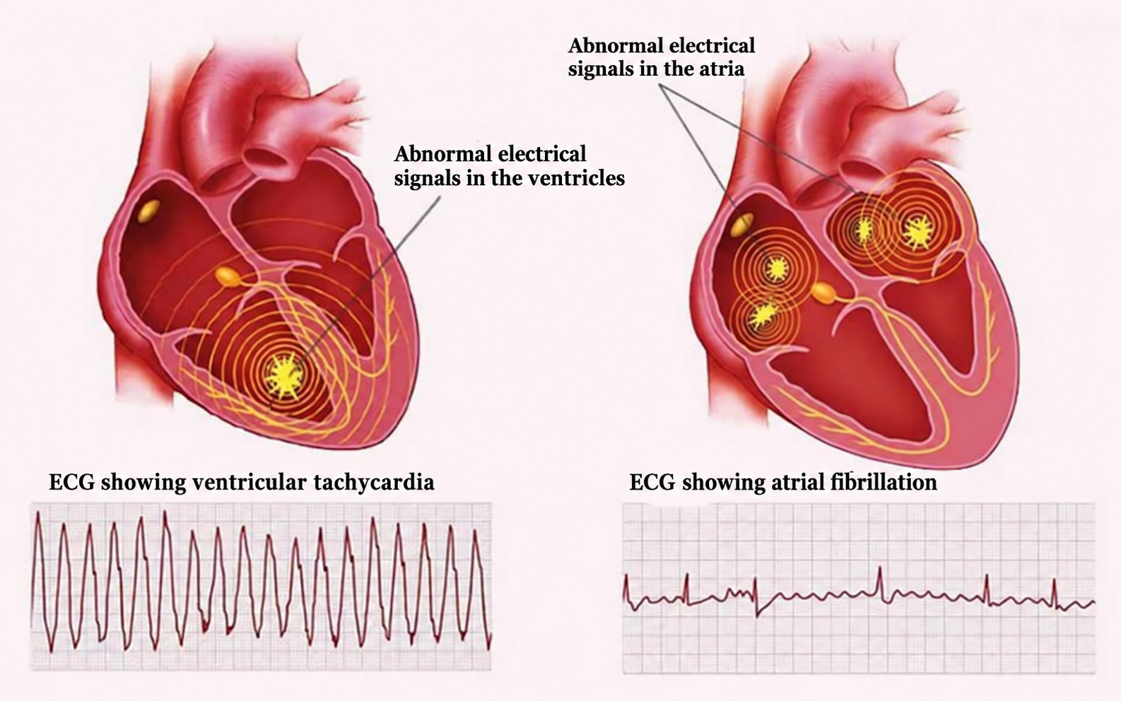 Cardiac arrhythmias and atrial fibrillation.