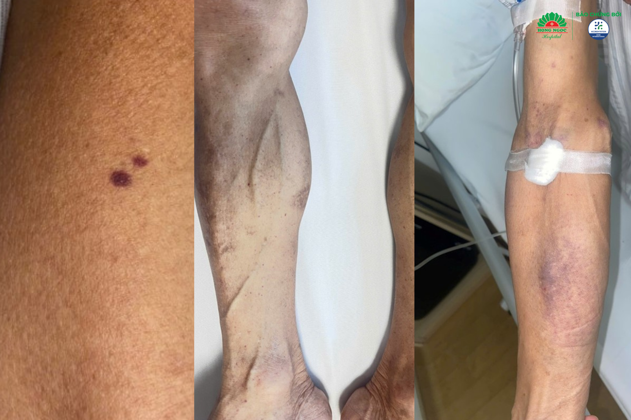 Giảm tiểu cầu ở mức nghiêm trọng khiến người bệnh xuất hiện các vết bầm tím trên cơ thể.