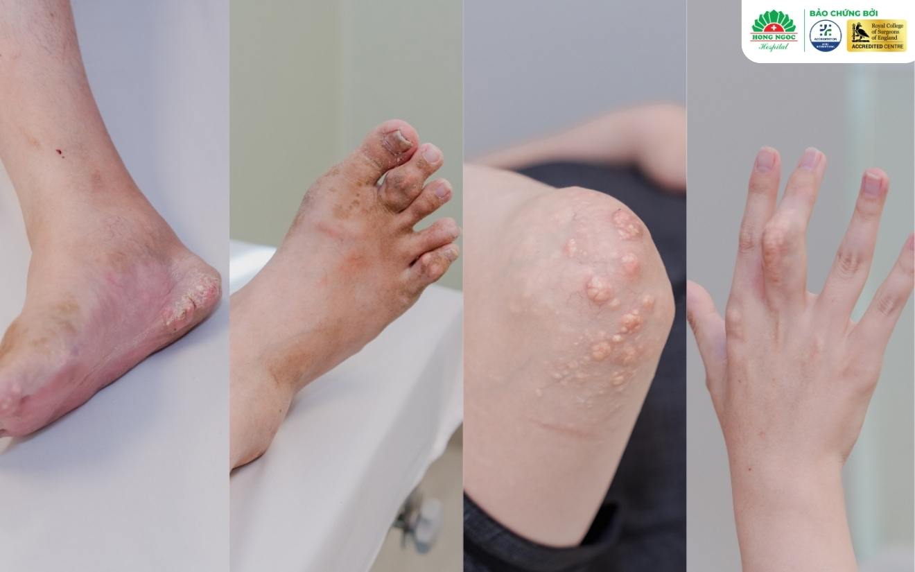 Nhiều khối tophi tích tụ, gây biến dạng khớp