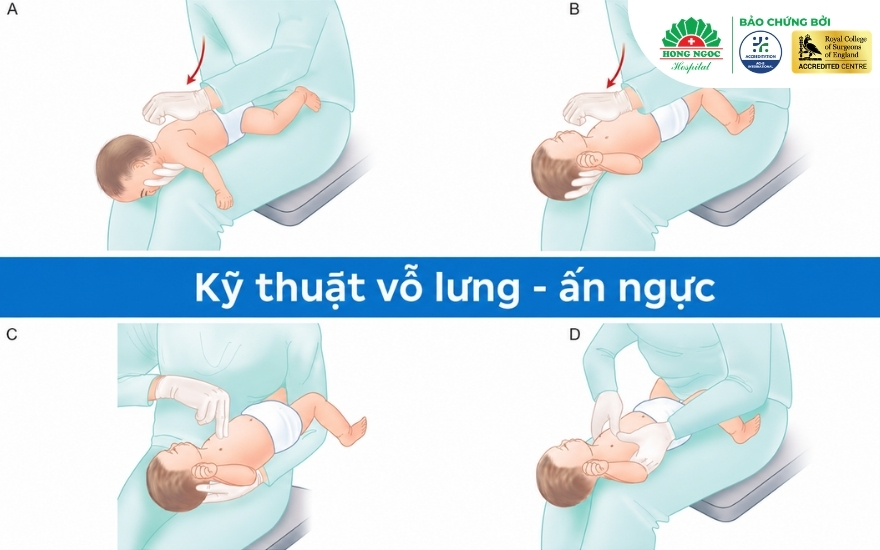 Kỹ thuật vỗ lưng - ấn ngực sơ cứu hóc dị vật đường thở áp dụng cho trẻ dưới 1 tuổi