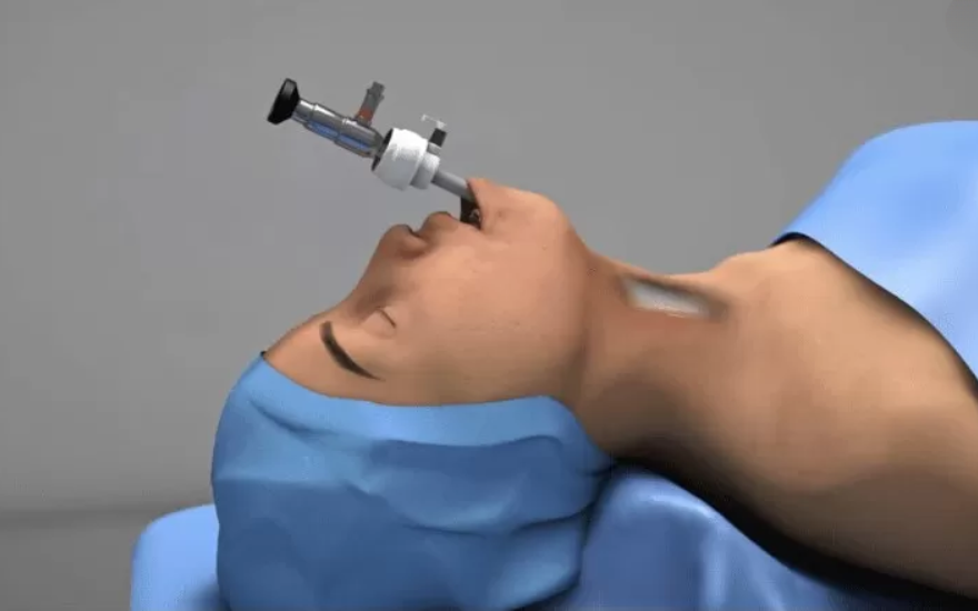 Phương pháp mổ nội soi tuyến giáp qua đường tiền đình miệng
