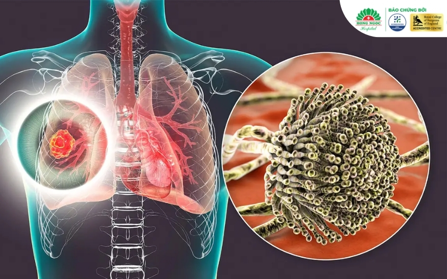 Bệnh nấm phổi không lây truyền từ người sang người