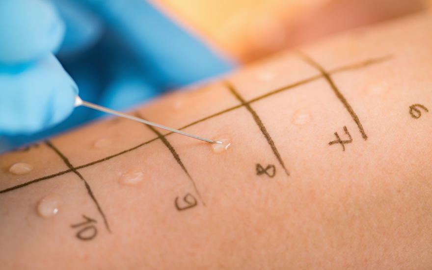 test-di-ung-da.png Skin testing helps identify the allergen responsible for an allergic reaction.