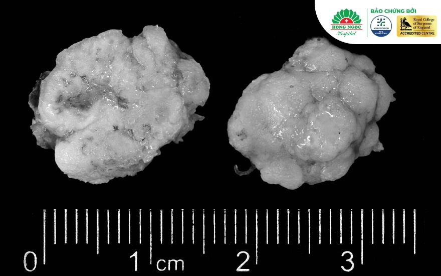U sụn phổi (Hamartoma) là loại u phổi lành tính phổ biến nhất