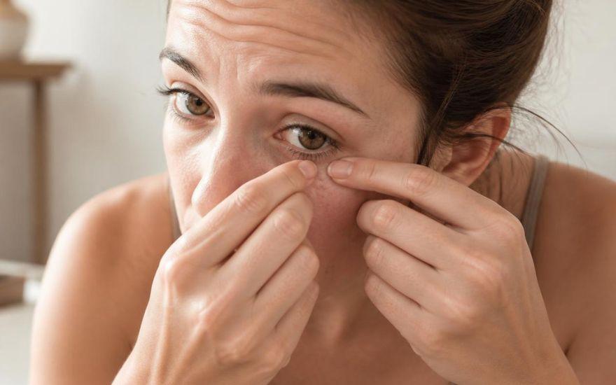 Tuyệt đối không dùng tay tự nặn mụn quanh mắt để tránh nguy cơ nhiễm trùng máu và suy giảm thị lực.