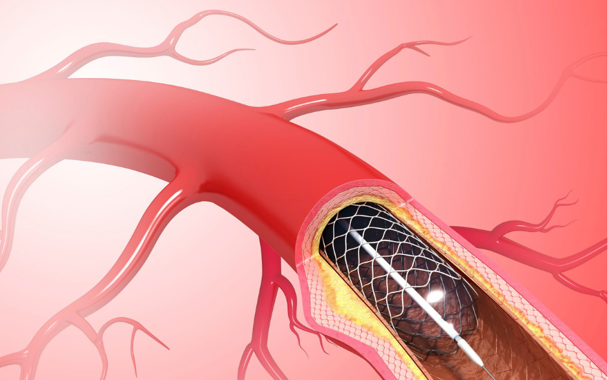 Người đặt stent có thể uống cà phê nếu đã ổn định và không có chống chỉ định từ bác sĩ