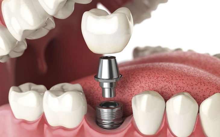 implant