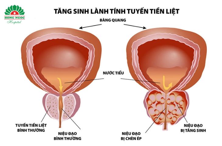 Phì đại tuyến tiền liệt là tình trạng tuyến tiền liệt phát triển quá mức bình thường, thường gặp ở nam giới tuổi trung niên