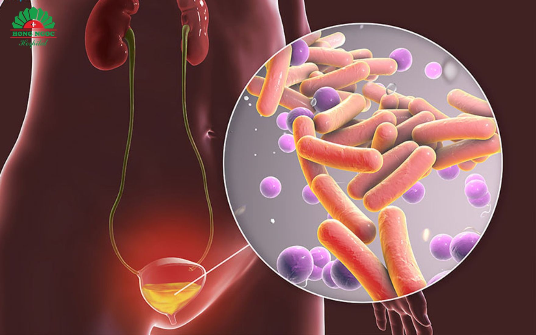 Urinary tract infection is one of the complications caused by urethral stones.