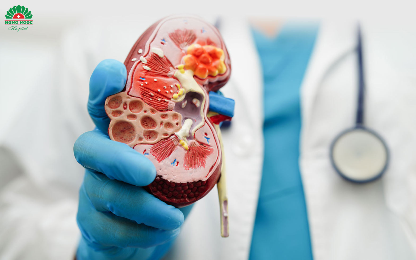 Kidney stones – a threat to urinary health