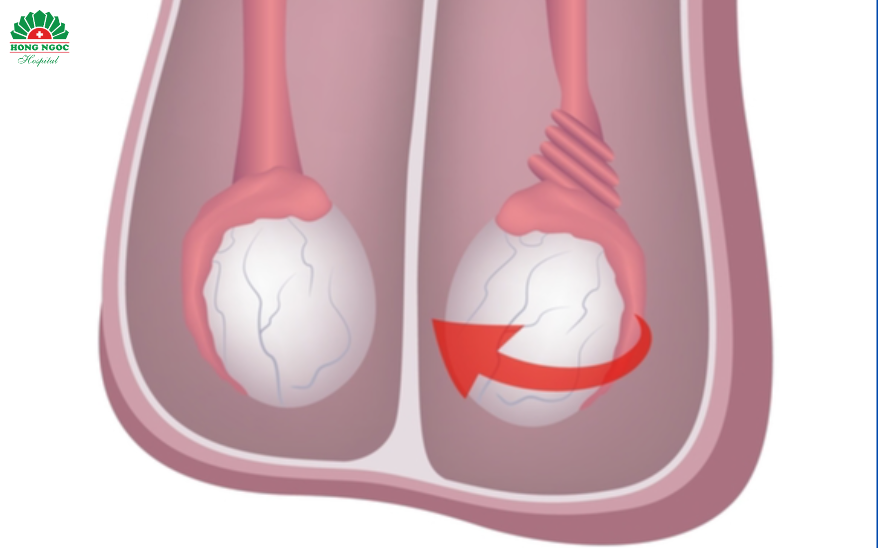 Complications of testicular torsion are highly serious and can affect male fertility.
