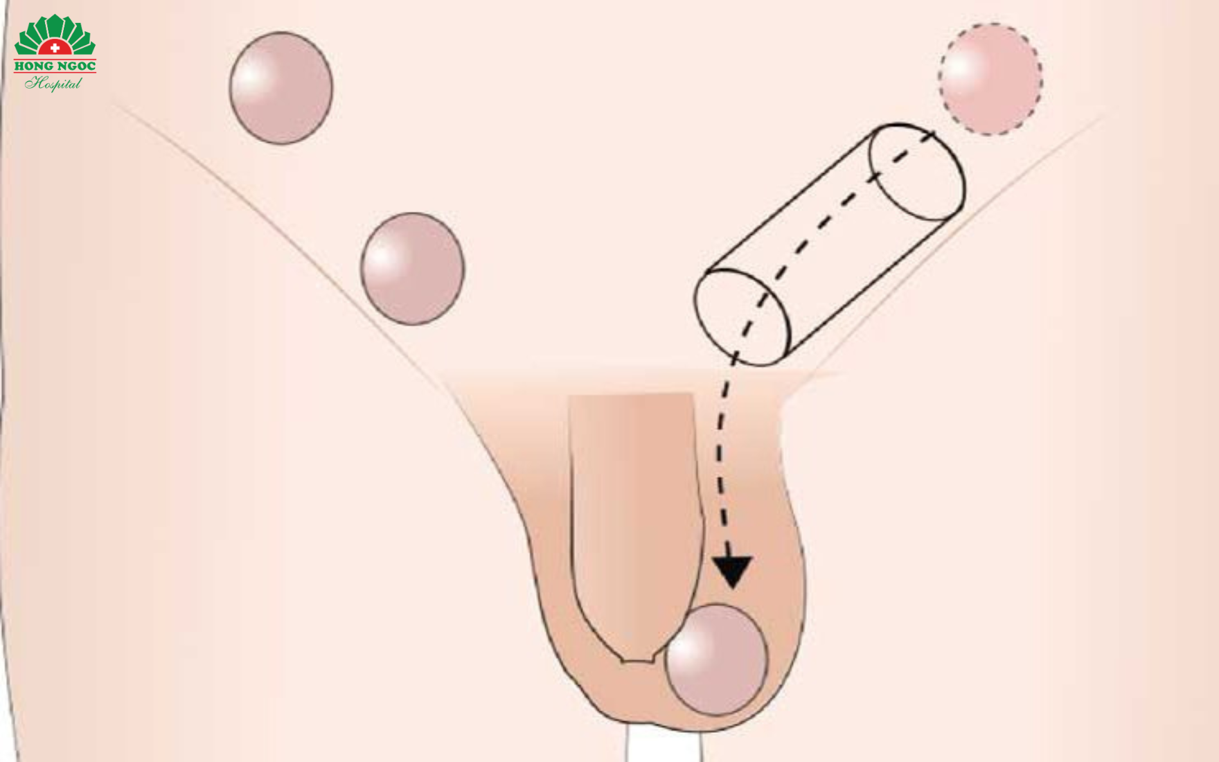 Testis not descending into the scrotum.