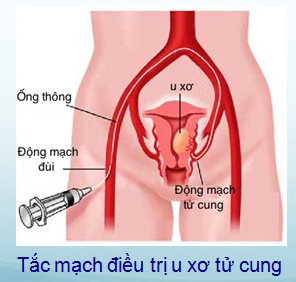 tắc mạch u xơ tử cung