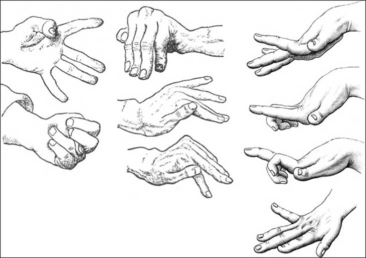 bệnh múa giật