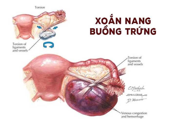 xoắn buồng trứng