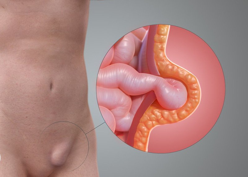 Chứng sa ruột thoát vị bẹn