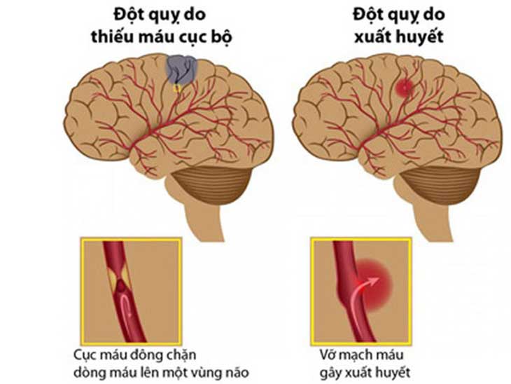 Đột quỵ não
