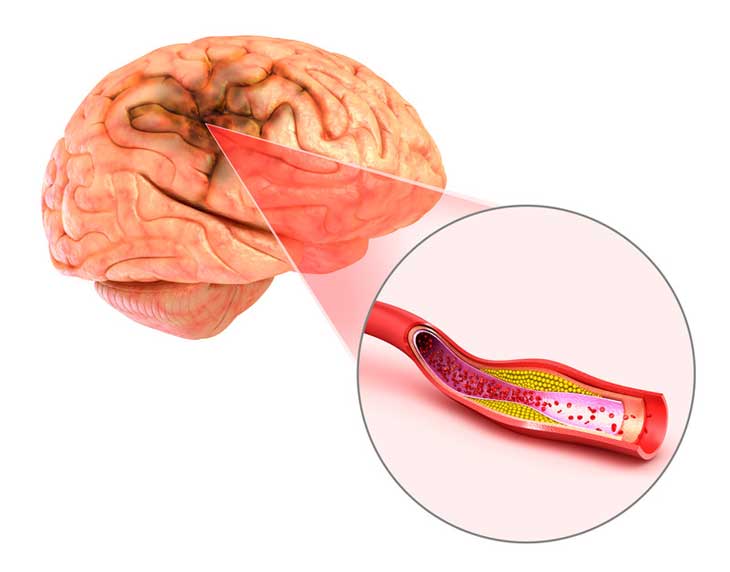 Đột quỵ não