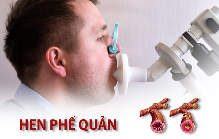 giãn phế nang